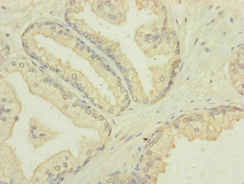 IF3mt / MTIF3 Antibody - Immunohistochemistry of paraffin-embedded human prostate cancer at dilution of 1:100