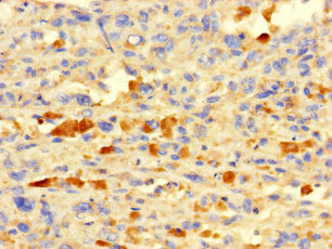 IFI27L2 Antibody - Immunohistochemistry of paraffin-embedded human melanoma using IFI27L2 Antibody at dilution of 1:100