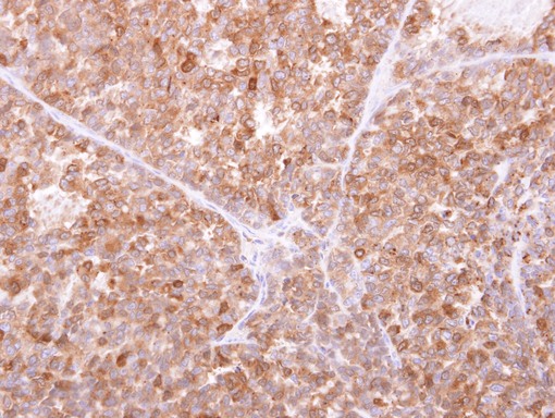 IFI30 / IP30 Antibody - GILT antibody detects IFI30 protein at cytosol on AGS xenograft by immunohistochemical analysis. Sample: Paraffin-embedded AGS xenograft. GILT antibody dilution:1:500.