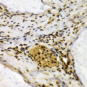 IFIH1 / MDA5 Antibody - Immunohistochemistry of paraffin-embedded human colon cancer tissue.