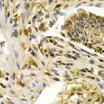 IFIH1 / MDA5 Antibody - Immunohistochemistry of paraffin-embedded human esophagus cancer tissue.