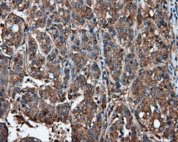 IFIT1 / ISG56 Antibody - IHC of paraffin-embedded Carcinoma of Human liver tissue using anti-IFIT1 mouse monoclonal antibody.