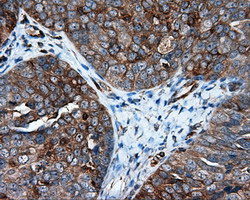 IFIT1 / ISG56 Antibody - IHC of paraffin-embedded Adenocarcinoma of Human ovary tissue using anti-IFIT1 mouse monoclonal antibody.