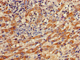 IFIT1 / ISG56 Antibody - Immunohistochemistry of paraffin-embedded human liver cancer using IFIT1 Antibody at dilution of 1:100