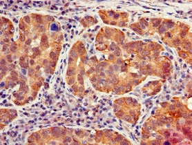 IFIT1 / ISG56 Antibody - Immunohistochemistry of paraffin-embedded human pancreatic cancer using IFIT1 Antibody at dilution of 1:100