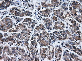 IFIT3 Antibody - Immunohistochemical staining of paraffin-embedded Carcinoma of liver tissue using anti-IFIT3 mouse monoclonal antibody. (Dilution 1:50).