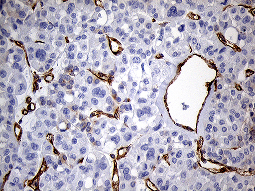IFITM2 Antibody - Immunohistochemical staining of paraffin-embedded Carcinoma of Human kidney tissue using anti-IFITM2 mouse monoclonal antibody. (Heat-induced epitope retrieval by 1mM EDTA in 10mM Tris buffer. (pH8.5) at 120°C for 3 min. (1:2000)