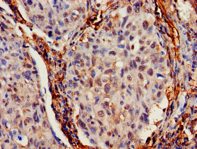 IFITM2 Antibody - IHC image of IFITM2 Antibody diluted at 1:700 and staining in paraffin-embedded human lung cancer performed on a Leica BondTM system. After dewaxing and hydration, antigen retrieval was mediated by high pressure in a citrate buffer (pH 6.0). Section was blocked with 10% normal goat serum 30min at RT. Then primary antibody (1% BSA) was incubated at 4°C overnight. The primary is detected by a biotinylated secondary antibody and visualized using an HRP conjugated SP system.