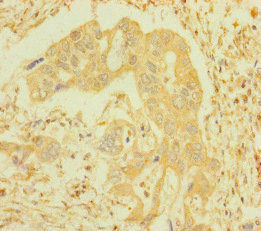 IFITM5 Antibody - Immunohistochemistry of paraffin-embedded human pancreatic cancer at dilution of 1:100