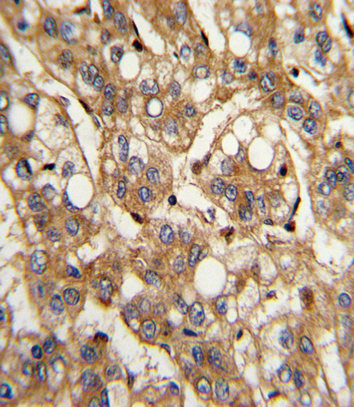IFN Beta / Interferon Beta Antibody - Formalin-fixed and paraffin-embedded human hepatocarcinoma with IFNB1 Antibody , which was peroxidase-conjugated to the secondary antibody, followed by DAB staining. This data demonstrates the use of this antibody for immunohistochemistry; clinical relevance has not been evaluated.