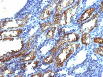 IFN Gamma / Interferon Gamma Antibody - IHC testing of FFPE human renal cell carcinoma with IFN gamma antibody (clone IFNG/466). Required HIER: boil tissue sections in 10mM Tris with 1mM EDTA, pH 9.0, for 10-20 min.