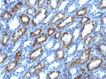 IFN Gamma / Interferon Gamma Antibody - IHC testing of FFPE human renal cell carcinoma with IFN gamma antibody (clone IFNG/466). Required HIER: boil tissue sections in 10mM Tris with 1mM EDTA, pH 9.0, for 10-20 min.