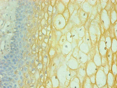IFN Gamma / Interferon Gamma Antibody - Immunohistochemical of paraffin-embedded human cervical using IFNG Monoclonal Antibody at dilution of 1:200