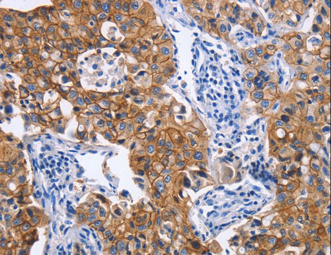 IFN Gamma / Interferon Gamma Antibody - Immunohistochemistry of paraffin-embedded Human lung cancer using IFNG Polyclonal Antibody at dilution of 1:30.