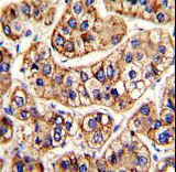 IFNAR1 / IFNAR Antibody - Formalin-fixed and paraffin-embedded human hepatocarcinoma with IFNAR1 Antibody , which was peroxidase-conjugated to the secondary antibody, followed by DAB staining. This data demonstrates the use of this antibody for immunohistochemistry; clinical relevance has not been evaluated.