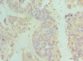 IFNAR2 Antibody - Immunohistochemistry of paraffin-embedded human endometrial cancer using antibody at 1:100 dilution.
