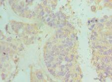 IFNAR2 Antibody - Immunohistochemistry of paraffin-embedded human endometrial cancer using antibody at 1:100 dilution.