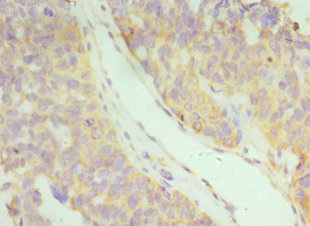 IFNAR2 Antibody - Immunohistochemistry of paraffin-embedded human endometrial cancer using IFNAR2 Antibody at dilution of 1:100