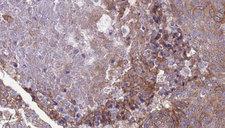IFNAR2 Antibody - 1:100 staining human urothelial carcinoma tissue by IHC-P. The sample was formaldehyde fixed and a heat mediated antigen retrieval step in citrate buffer was performed. The sample was then blocked and incubated with the antibody for 1.5 hours at 22°C. An HRP conjugated goat anti-rabbit antibody was used as the secondary.