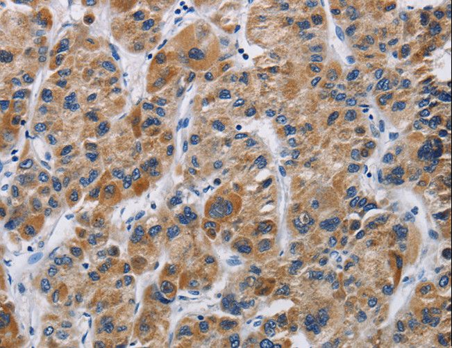 IFNGR2 Antibody - Immunohistochemistry of paraffin-embedded Human liver cancer using IFNGR2 Polyclonal Antibody at dilution of 1:40.