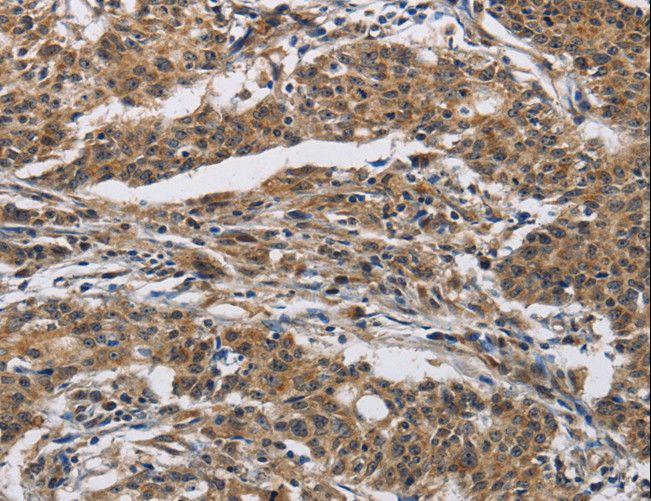 IFNGR2 Antibody - Immunohistochemistry of paraffin-embedded Human gastric cancer using IFNGR2 Polyclonal Antibody at dilution of 1:40.