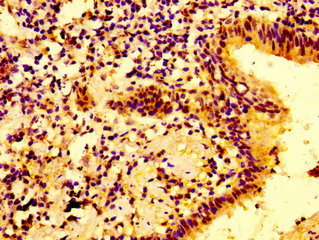 IFNGR2 Antibody - Immunohistochemistry image at a dilution of 1:100 and staining in paraffin-embedded human lung cancer performed on a Leica BondTM system. After dewaxing and hydration, antigen retrieval was mediated by high pressure in a citrate buffer (pH 6.0) . Section was blocked with 10% normal goat serum 30min at RT. Then primary antibody (1% BSA) was incubated at 4 °C overnight. The primary is detected by a biotinylated secondary antibody and visualized using an HRP conjugated SP system.
