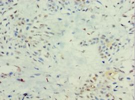 IFNL1 / IL29 Antibody - Immunohistochemistry of paraffin-embedded human breast cancer using antibody at 1:100 dilution.