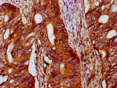 IFT172 Antibody - Immunohistochemistry Dilution at 1:400 and staining in paraffin-embedded human colon cancer performed on a Leica BondTM system. After dewaxing and hydration, antigen retrieval was mediated by high pressure in a citrate buffer (pH 6.0). Section was blocked with 10% normal Goat serum 30min at RT. Then primary antibody (1% BSA) was incubated at 4°C overnight. The primary is detected by a biotinylated Secondary antibody and visualized using an HRP conjugated SP system.