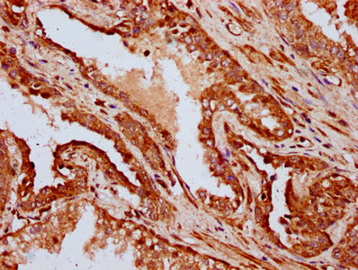 IFT172 Antibody - Immunohistochemistry Dilution at 1:400 and staining in paraffin-embedded human prostate cancer performed on a Leica BondTM system. After dewaxing and hydration, antigen retrieval was mediated by high pressure in a citrate buffer (pH 6.0). Section was blocked with 10% normal Goat serum 30min at RT. Then primary antibody (1% BSA) was incubated at 4°C overnight. The primary is detected by a biotinylated Secondary antibody and visualized using an HRP conjugated SP system.