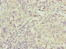 IFT20 Antibody - Immunohistochemistry of paraffin-embedded human liver cancer at dilution of 1:100