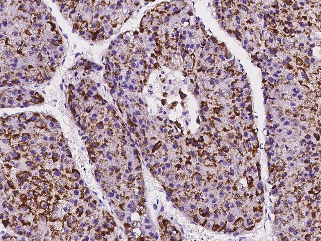 IFT20 Antibody - Immunochemical staining of human IFT20 in human hepatoma with rabbit polyclonal antibody at 1:1000 dilution, formalin-fixed paraffin embedded sections.