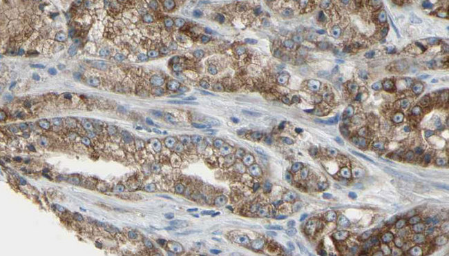 IFT22 / RABL5 Antibody - 1:100 staining human prostate tissue by IHC-P. The sample was formaldehyde fixed and a heat mediated antigen retrieval step in citrate buffer was performed. The sample was then blocked and incubated with the antibody for 1.5 hours at 22°C. An HRP conjugated goat anti-rabbit antibody was used as the secondary.