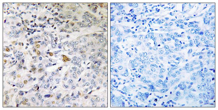 IFT22 / RABL5 Antibody - Peptide - + Immunohistochemistry analysis of paraffin-embedded human breast carcinoma tissue using RABL5 antibody.