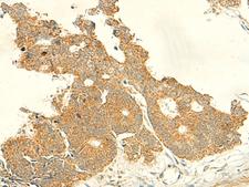 IFT27 / RABL4 Antibody - Immunohistochemistry of paraffin-embedded Human colorectal cancer tissue  using IFT27 Polyclonal Antibody at dilution of 1:50(×200)
