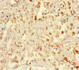 IFT46 Antibody - Immunohistochemistry of paraffin-embedded human melanoma cancer at dilution of 1:100