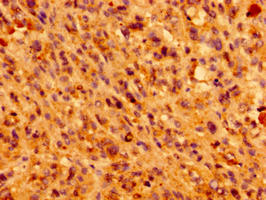 IFT46 Antibody - Immunohistochemistry of paraffin-embedded human melanoma using IFT46 Antibody at dilution of 1:100