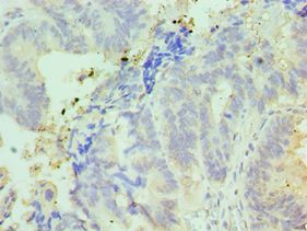 IFT57 / HIPPI Antibody - Immunohistochemistry of paraffin-embedded human colon cancer using antibody at 1:100 dilution.