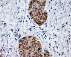 IFT57 / HIPPI Antibody - IHC of paraffin-embedded Carcinoma of pancreas tissue using anti-IFT57 mouse monoclonal antibody. (Dilution 1:50).