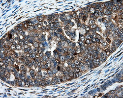 IFT57 / HIPPI Antibody - IHC of paraffin-embedded Adenocarcinoma of ovary tissue using anti-IFT57 mouse monoclonal antibody. (Dilution 1:50).
