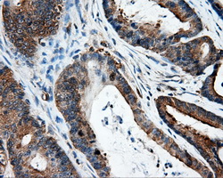 IFT57 / HIPPI Antibody - IHC of paraffin-embedded Adenocarcinoma of colon tissue using anti-IFT57 mouse monoclonal antibody. (Dilution 1:50).