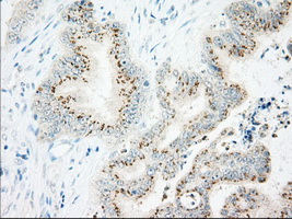 IFT57 / HIPPI Antibody - IHC of paraffin-embedded Adenocarcinoma of Human colon tissue using anti-IFT57 mouse monoclonal antibody. (Dilution 1:50).