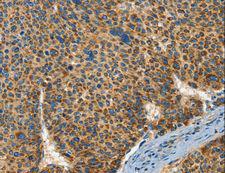 IFT74 / CCDC2 Antibody - Immunohistochemistry of paraffin-embedded Human breast cancer using IFT74 Polyclonal Antibody at dilution of 1:60.