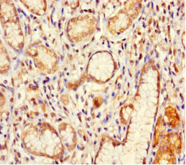 IFT80 Antibody - Immunohistochemistry of paraffin-embedded human gastric cancer using IFT80 Antibody at dilution of 1:100