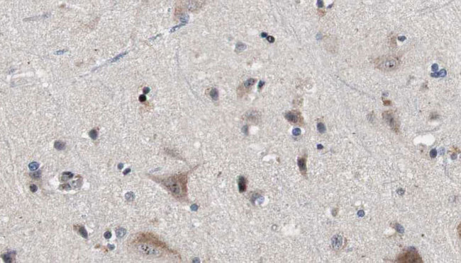IFT81 Antibody - 1:100 staining human brain carcinoma tissue by IHC-P. The sample was formaldehyde fixed and a heat mediated antigen retrieval step in citrate buffer was performed. The sample was then blocked and incubated with the antibody for 1.5 hours at 22°C. An HRP conjugated goat anti-rabbit antibody was used as the secondary.