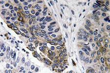 IgA Antibody - Immunohistochemistry analysis of IgA antibody in paraffin-embedded human lung carcinoma tissue.