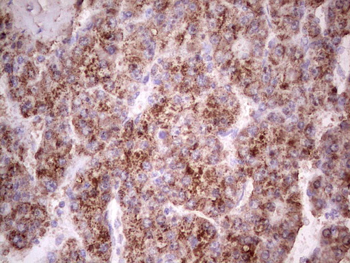 IGF1 Antibody - Immunohistochemical staining of paraffin-embedded Carcinoma of Human liver tissue using anti-IGF1 mouse monoclonal antibody. (Heat-induced epitope retrieval by 1 mM EDTA in 10mM Tris, pH8.5, 120C for 3min,