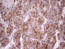 IGF1 Antibody - IHC of paraffin-embedded Carcinoma of Human liver tissue using anti-IGF1 mouse monoclonal antibody. (Heat-induced epitope retrieval by 1 mM EDTA in 10mM Tris, pH8.5, 120°C for 3min).