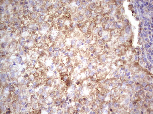 IGF1 Antibody - Immunohistochemical staining of paraffin-embedded Carcinoma of Human lung tissue using anti-IGF1 mouse monoclonal antibody. (Heat-induced epitope retrieval by 1 mM EDTA in 10mM Tris, pH8.5, 120C for 3min,