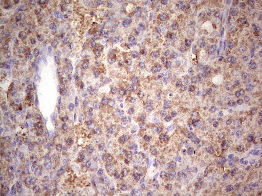 IGF1 Antibody - IHC of paraffin-embedded Carcinoma of Human liver tissue using anti-IGF1 mouse monoclonal antibody. (Heat-induced epitope retrieval by 1 mM EDTA in 10mM Tris, pH8.5, 120°C for 3min).