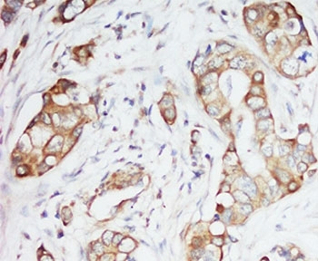 IGF1 Antibody - IHC-P: IGF-1 antibody testing of human breast cancer tissue